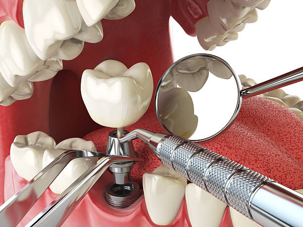Best Emergency Dental Care for Abscessed Tooth in El Centro, CA